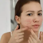 cách phục hồi làn da bị kích ứng tại nhà