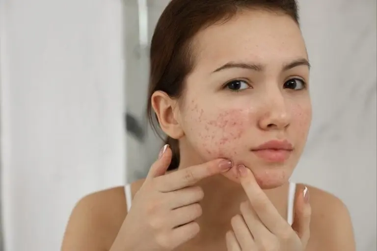 cách phục hồi làn da bị kích ứng tại nhà