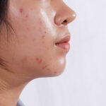 serum cho da dầu mụn giá học sinh