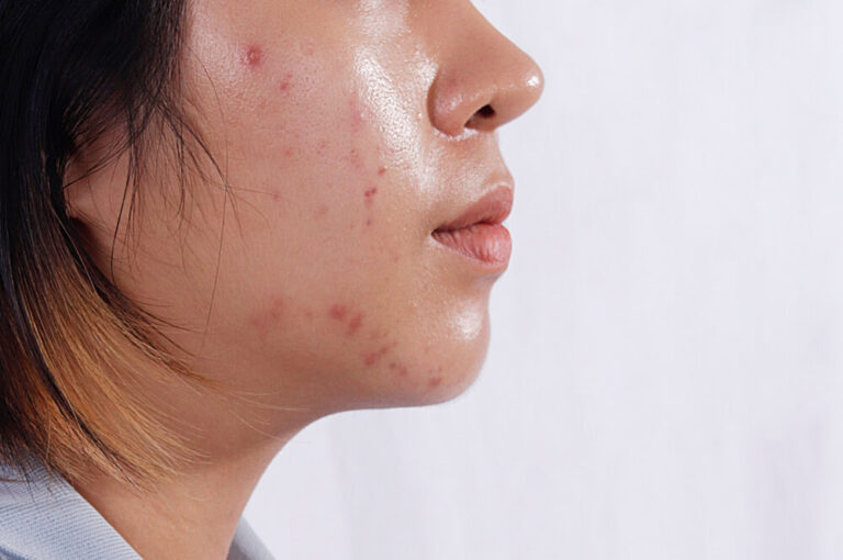 serum cho da dầu mụn giá học sinh